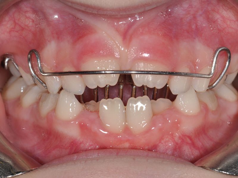 orthodontiki_kids3