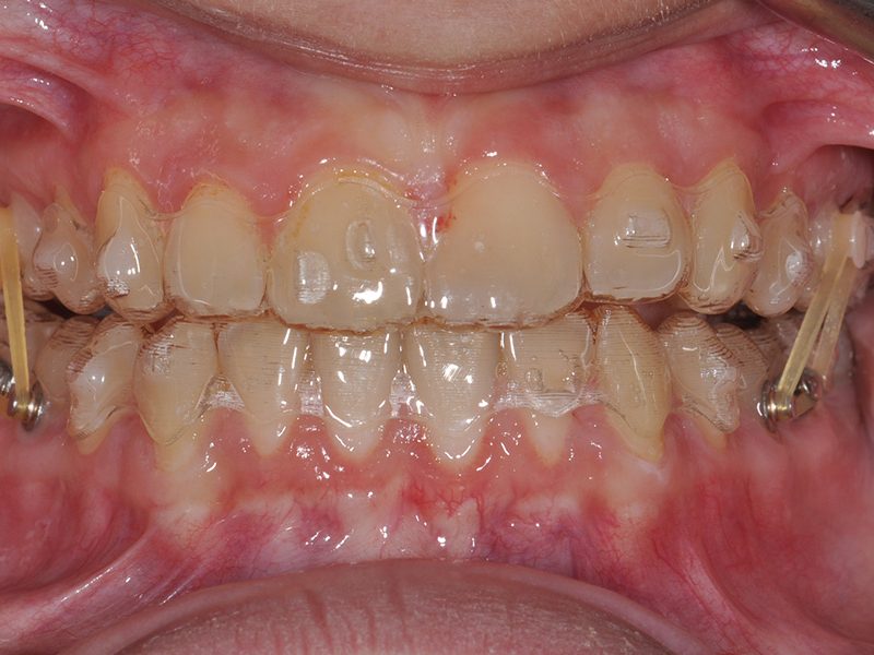INVISALIGN1