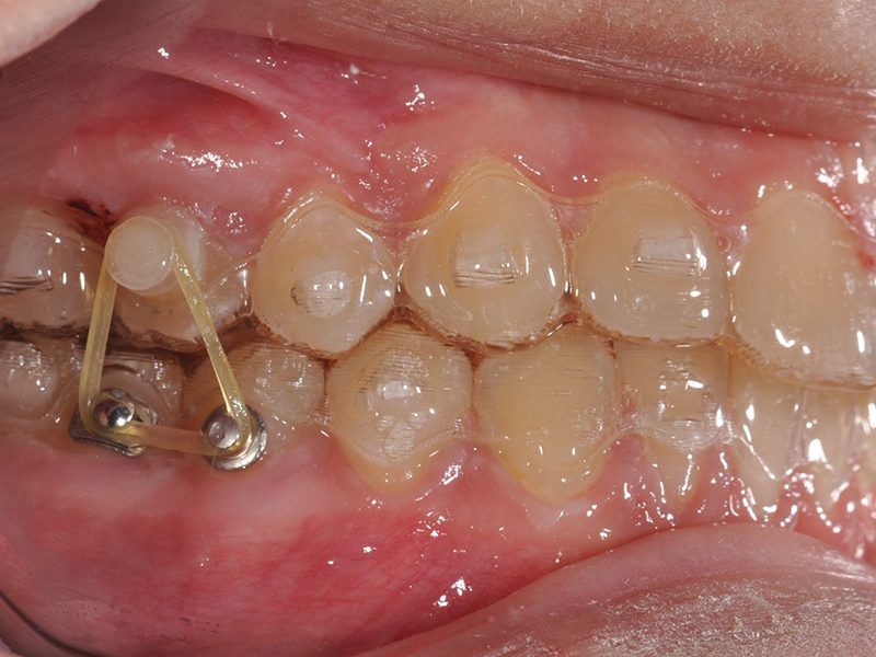 INVISALIGN2