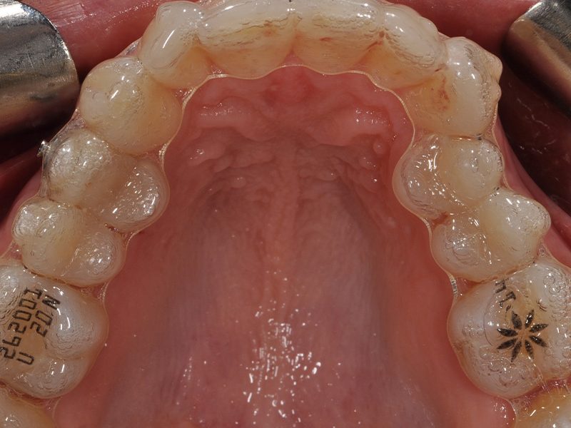 INVISALIGN3