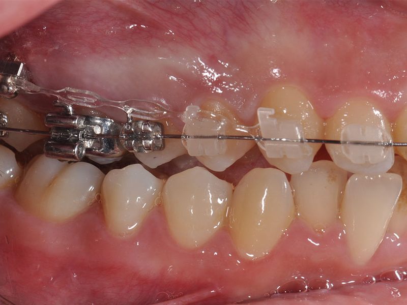 emfiteumata1