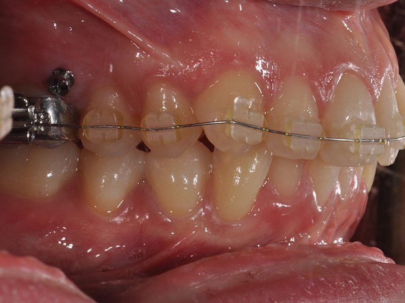 emfiteumata3