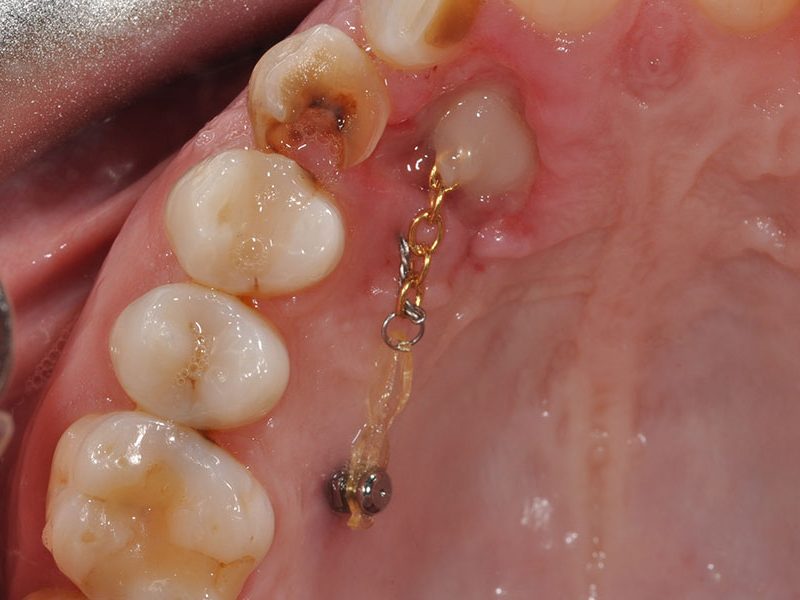 emfiteumataG